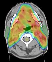 Els pacients amb càncer de cap i coll es beneficien de noves tècniques de radioteràpia avançada