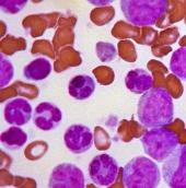 Un estudi, encapçalat per l'ICO en col·laboració de l’Institut Josep Carreras, revela l’efectivitat d’un nou tractament en leucèmia limfoblàstica
