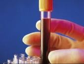La presència d’anticossos contra el VPH en sang indica un risc elevat de desenvolupar càncer d’orofaringe